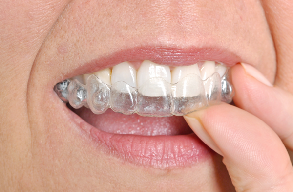 How To Make Your Invisalign Treatment Quick and Easy