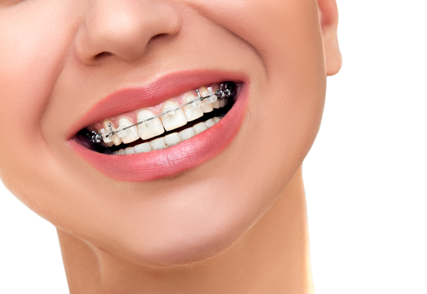 types-of-braces