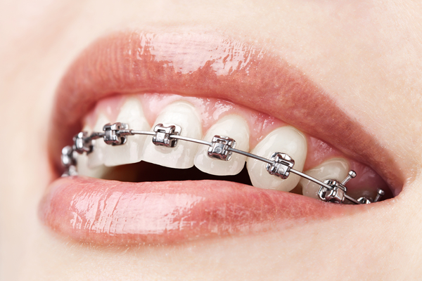 braces-procedure