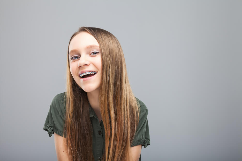 teeth white with braces