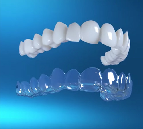 invisalign