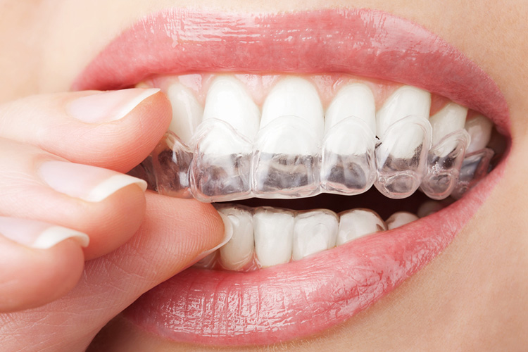 clear-aligners-placed-in-mouth