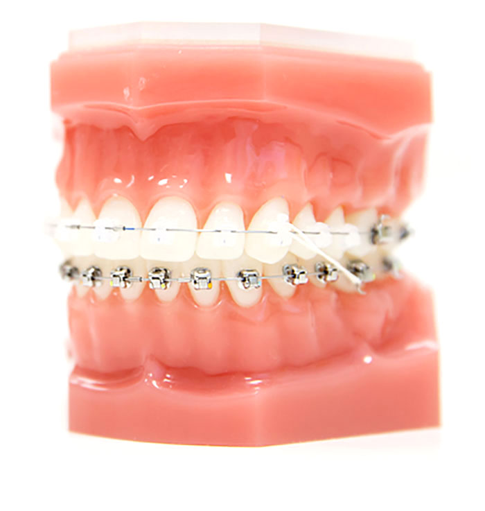 Self ligating braces on denture