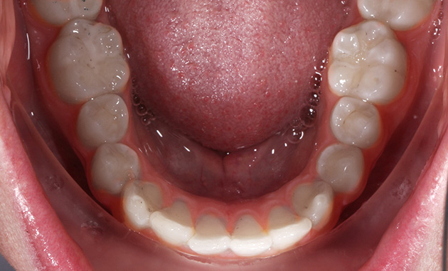 Lower Teeth