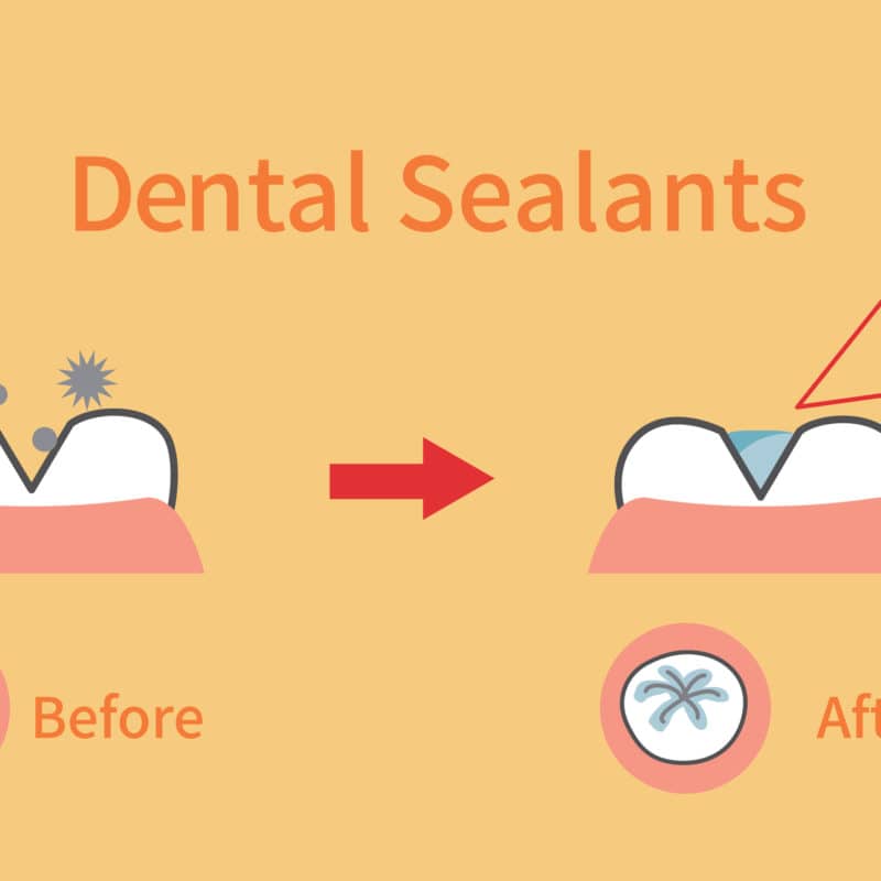 Dental Sealants