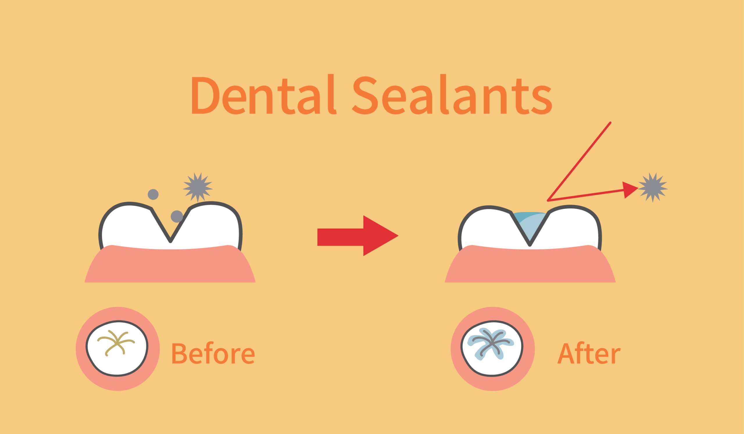 Dental Sealants