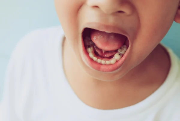 Child's teeth showing early decay – used to highlight how to prevent cavities