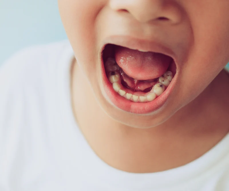 Child's teeth showing early decay – used to highlight how to prevent cavities