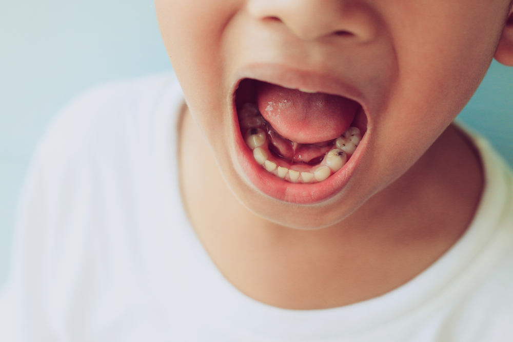Child's teeth showing early decay – used to highlight how to prevent cavities
